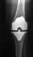 X-ray of total knee replacement prosthesis after surgery