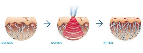 Exilis Ultra diagram