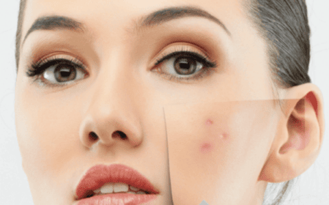 Choose your chemical peel – guide