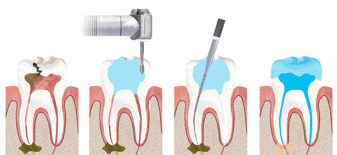 root canal treatment in Dubai