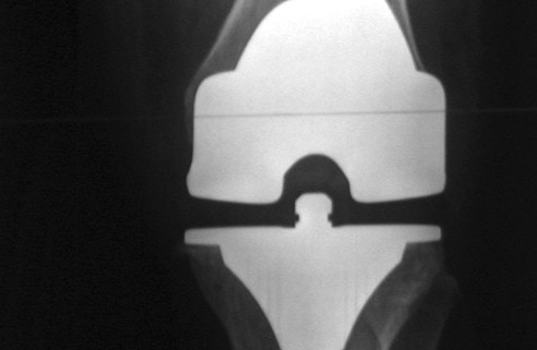 X-ray of total knee replacement prosthesis after surgery