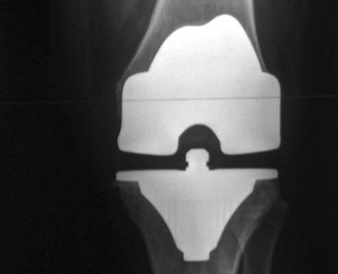 X-ray of total knee replacement prosthesis after surgery