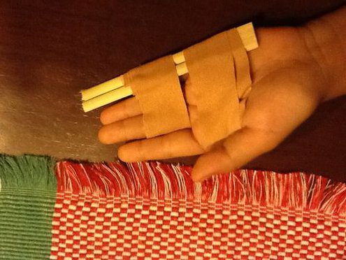 Dislocated Finger Rehab Bottom View