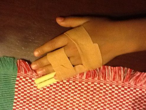 Dislocated Finger Rehab Top View