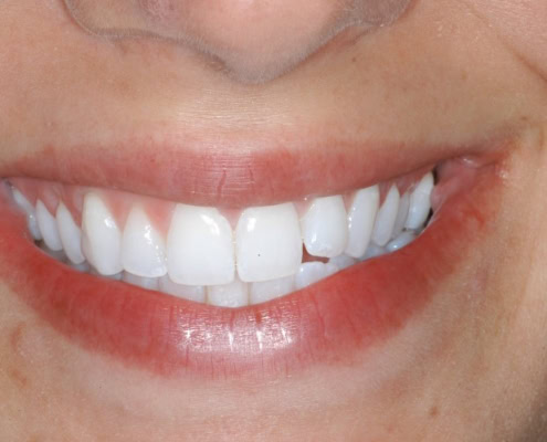 What are Invisalign braces- After Picture at Frangella Dental NYC