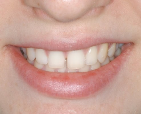 What are Invisalign braces- Before Picture at Frangella Dental NYC