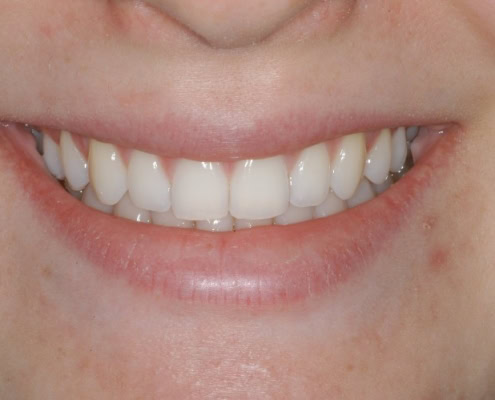 What are Invisalign braces- After Picture at Frangella Dental NYC