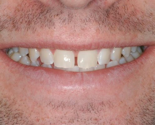 Invisalign braces- Before Picture at Frangella Dental NYC
