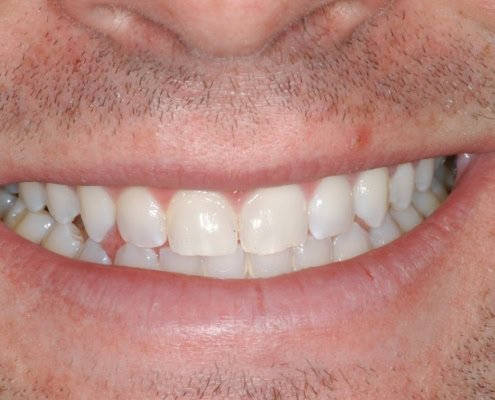 Invisalign braces- After Picture at Frangella Dental NYC