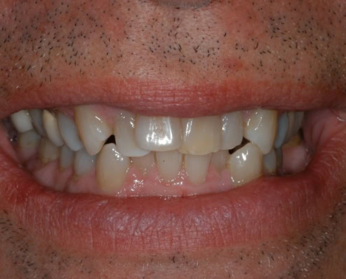 Frangella – invisalign_braces -07 - Frangella Dental NYC