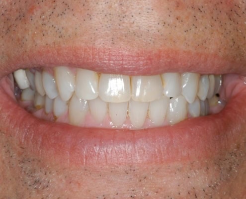 Invisalign braces in New York City – After Picture at Frangella Dental NYC