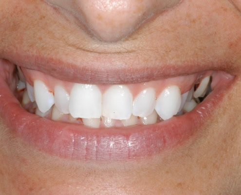 How much are Invisalign braces – Before Picture at Frangella Dental NYC