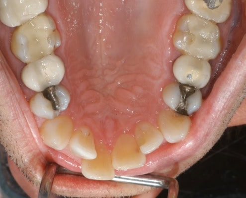 How much are Invisalign braces – Before Picture at Frangella Dental NYC