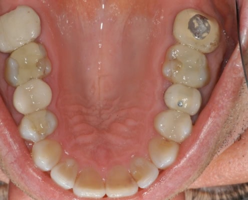 How much are Invisalign braces – After Picture at Frangella Dental NYC