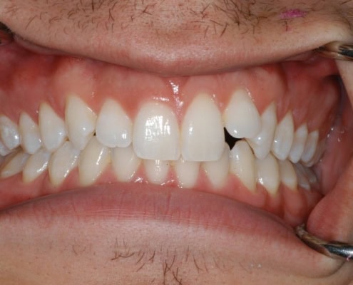 Invisalign braces – Before Picture at Frangella Dental NYC