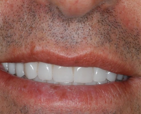 What are dental crowns – After Picture at Frangella Dental NYC