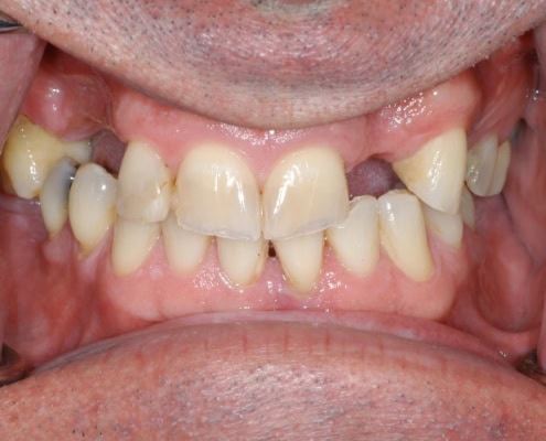 What are dental crowns – Before Picture at Frangella Dental NYC