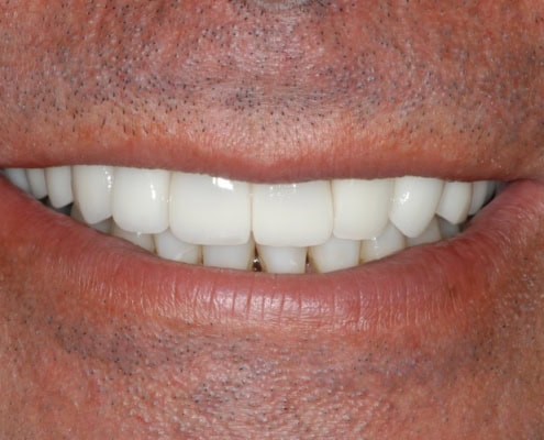 What are dental veneers – After Picture at Frangella Dental NYC
