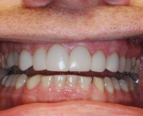Dental veneers procedure – Before Picture at Frangella Dental NYC