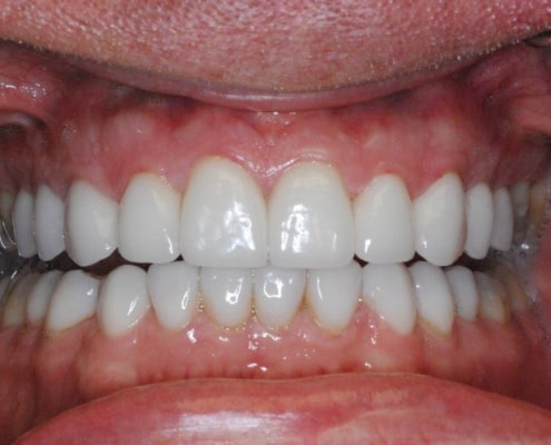Dental veneers procedure – After Picture at Frangella Dental NYC