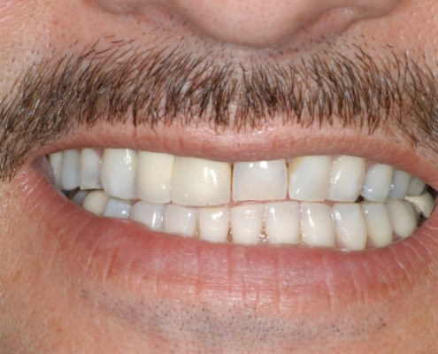 What are dental veneers – Before Picture at Frangella Dental NYC