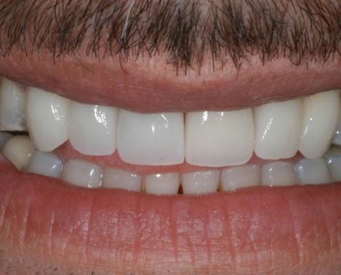 Dental veneers New York Dentist – After Picture at Frangella Dental NYC