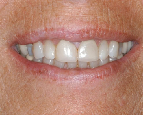 What are dental veneers – Before Picture at Frangella Dental NYC