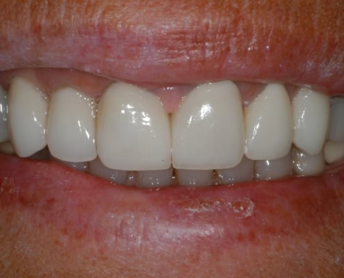 What are dental veneers – After Picture at Frangella Dental NYC