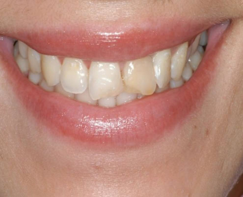 What are dental veneers – Before Picture at Frangella Dental NYC