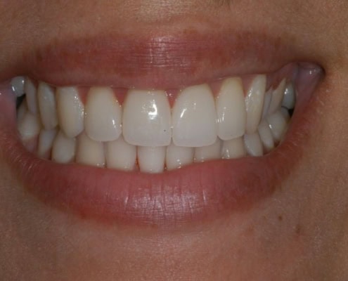 What are dental veneers – After Picture at Frangella Dental NYC