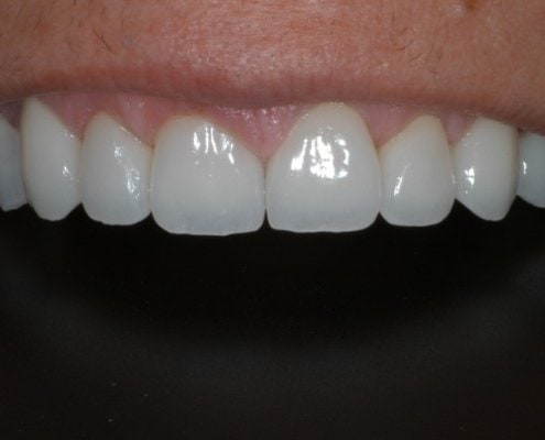 What are dental veneers – After Picture at Frangella Dental NYC