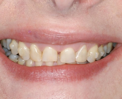 What are dental veneers – Before Picture at Frangella Dental NYC