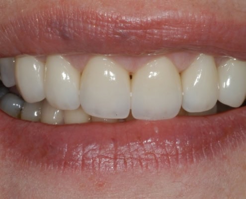 What are dental veneers – After Picture at Frangella Dental NYC