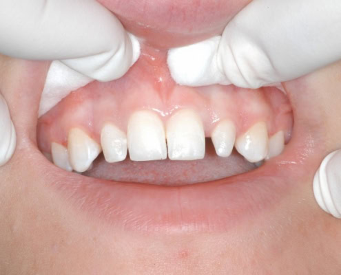 What are dental veneers – Before Picture at Frangella Dental NYC