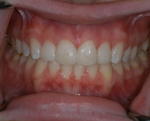 What is a dental veneer – After Picture at Frangella Dental NYC