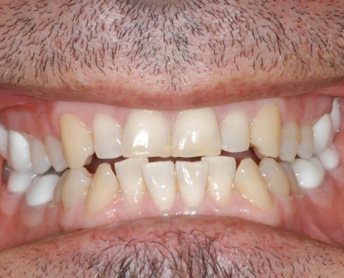 What is a dental veneer – Before Picture at Frangella Dental NYC