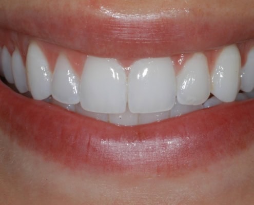 Invisalign braces – After at Frangella Dental NYC