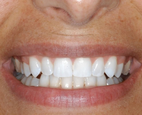 Invisalign braces – After Photo at Frangella Dental NYC