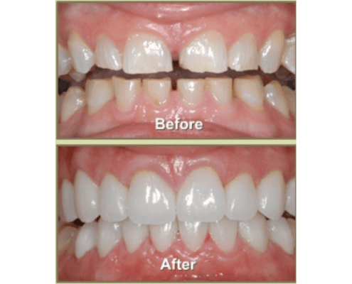 Veneers Before and After Photo at Frangella Dental NYC