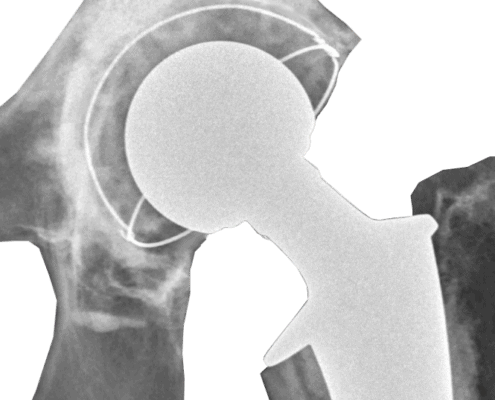 X-ray of total hip replacement prosthesis after surgery