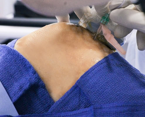 Knee injection procedure for pain control