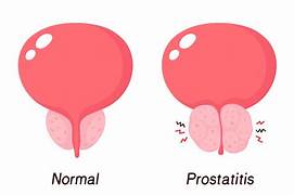 prostatite