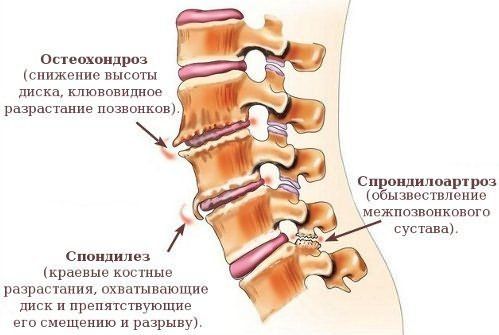 Разница между Спондилезом и Спондилолистезом 1 Осложнения Остеохондроза