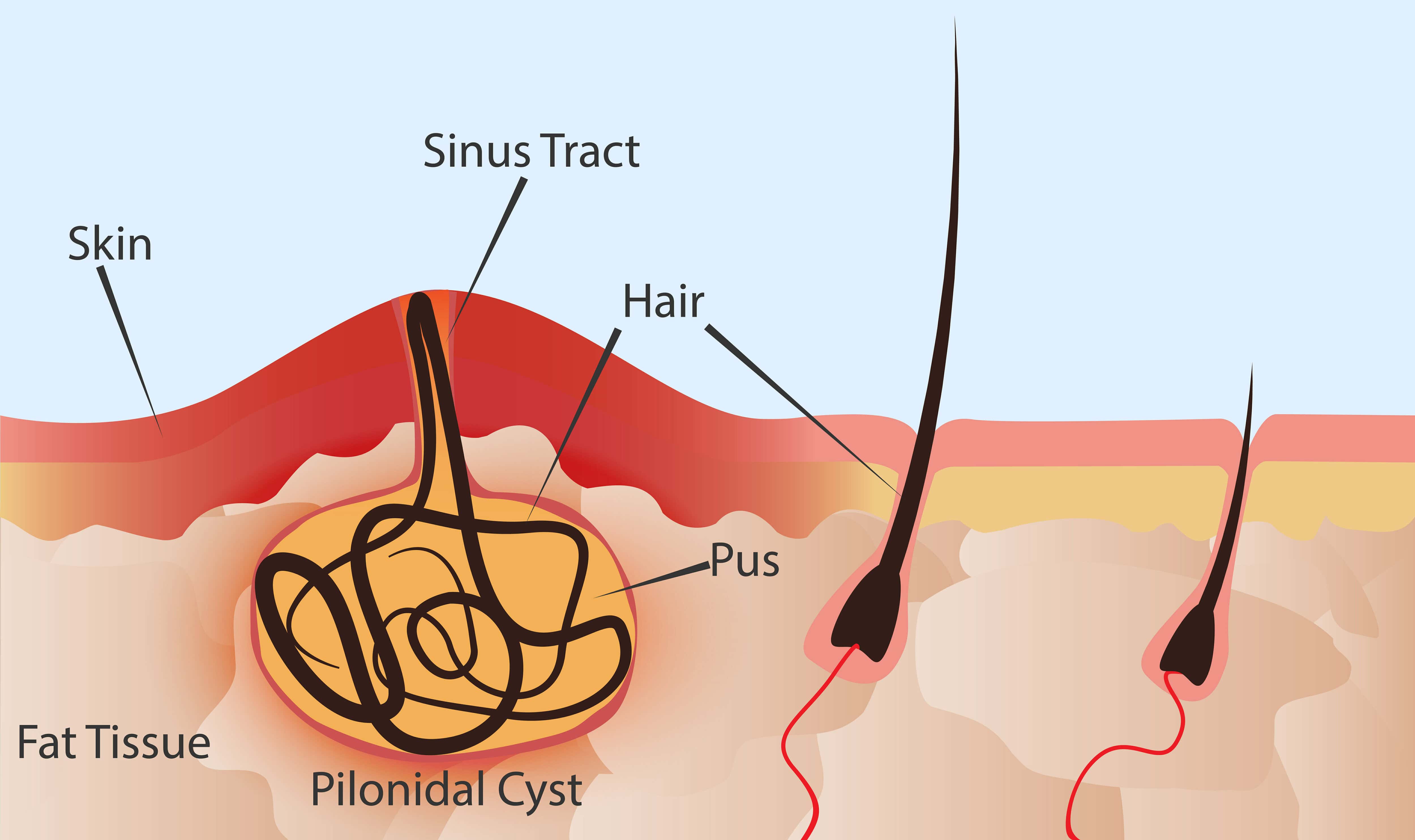 Pilonidal Cyst Affected Area: Where They Form, Why It Matters, and What to Watch For