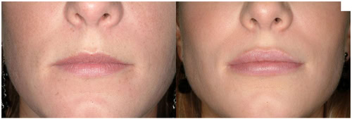 Aumento de labios clinica fontana 1