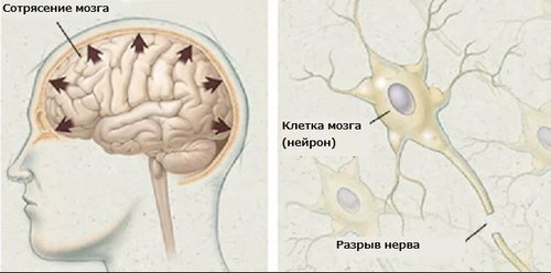 Разница между Сотрясением мозга и Контузией 2 Последствия при Сотрясении мозга