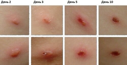 Разница между Ветрянкой и Опоясывающим лишаем 2 Стадии Ветрянки