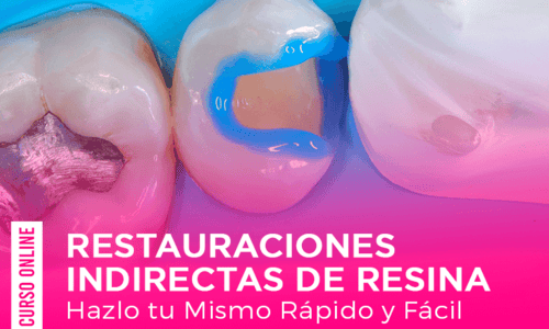 Restauraciones Indirectas de Resina : Hazlo tu Mismo Rápido y Fácil .