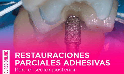 Restauraciones Parciales Adhesivas para el sector posterior