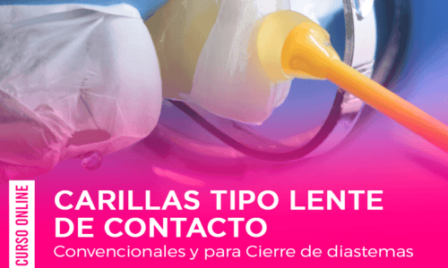 Carillas Tipo Lente de Contacto, Convencionales y Para Cierre de Diastemas.